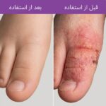 پماد رفع تخصصی خشکی و التهاب شدید پوستی ، اگزما، علائم پسوریازیس و قارچ (کره ای) - 3
